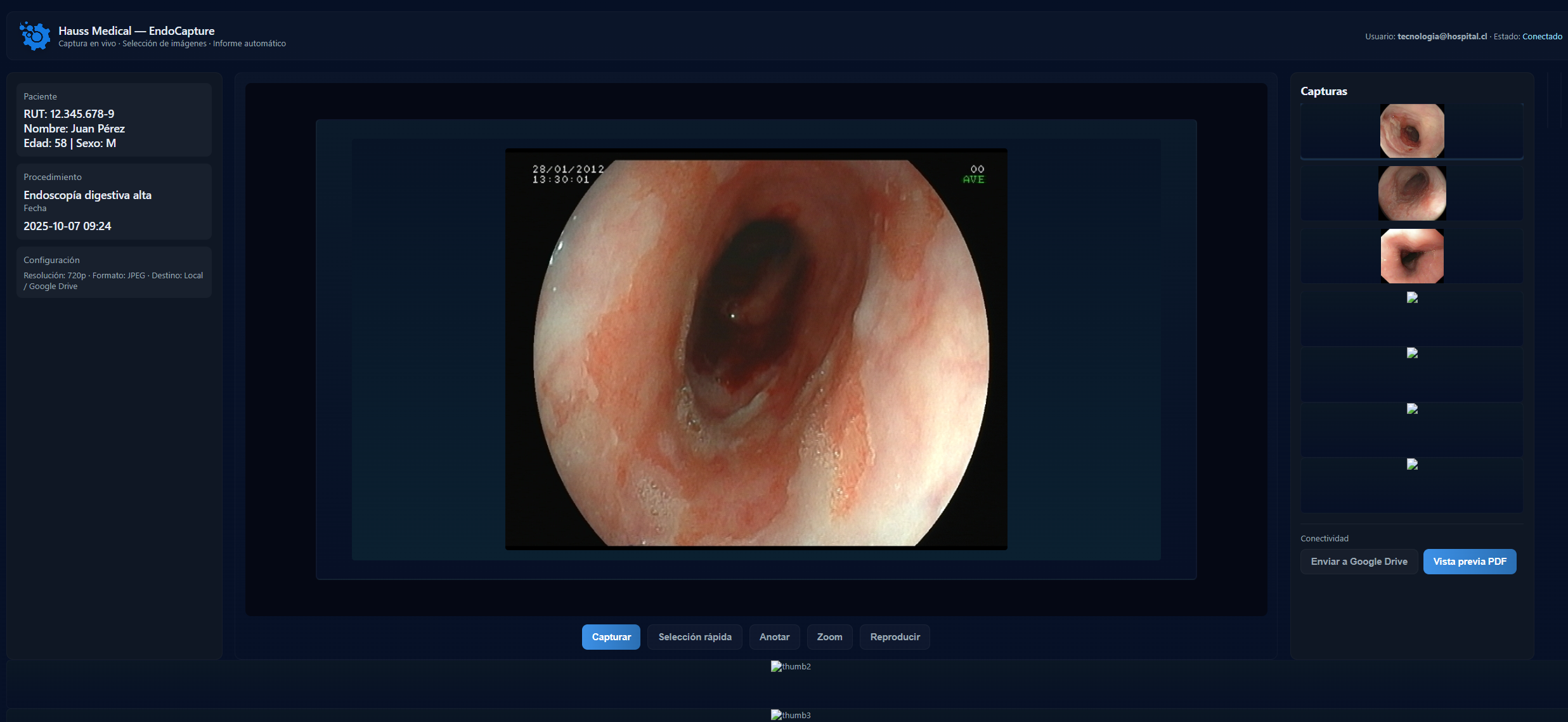 Software de endoscopía: captura en vivo y reporte automático en PDF - Hauss Medical